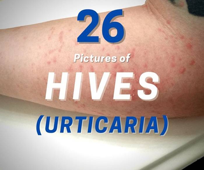 Hives Urticaria