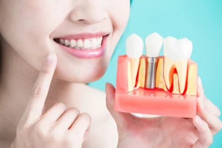 dental implant surgery preparation complete timeline guide