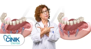 single dental implants vs hybridge which solution fits your smile
