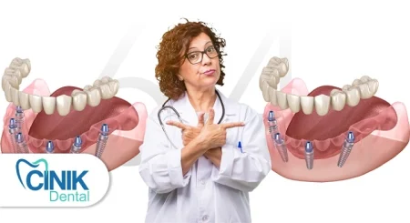 single dental implants vs hybridge which solution fits your smile