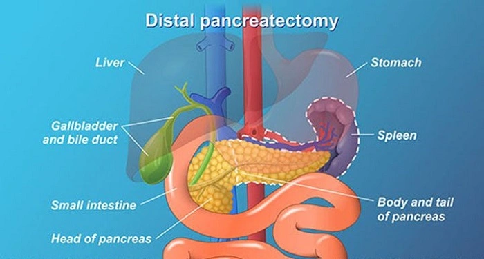 Causes for Pancreas Removal (Pancreatectomy)