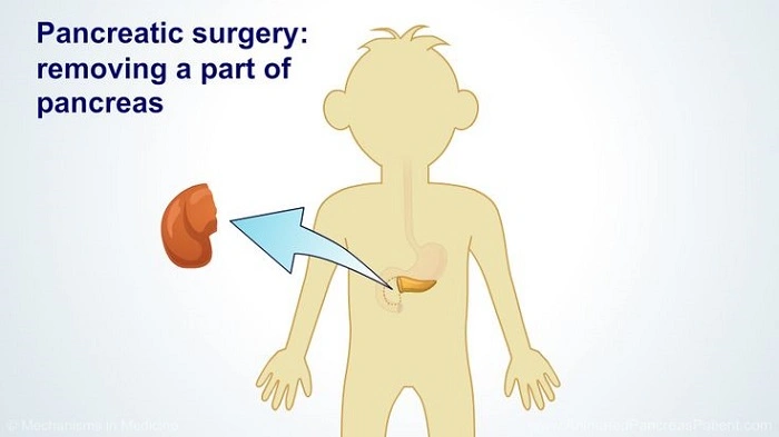 Managing Life After Pancreas Removal
