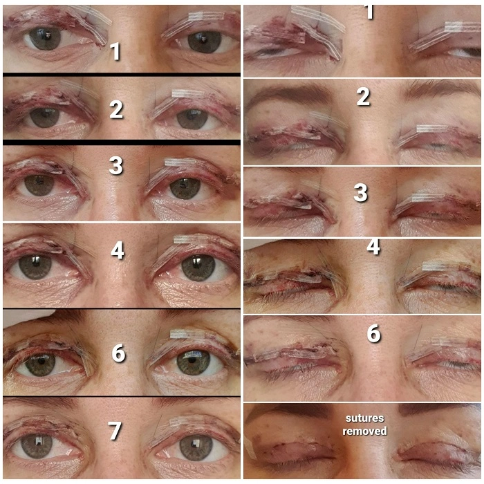 Recovery After Blepharoplasty