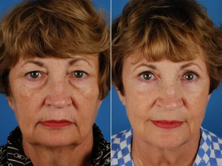 blepharoplasty