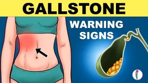 gallbladder symptoms