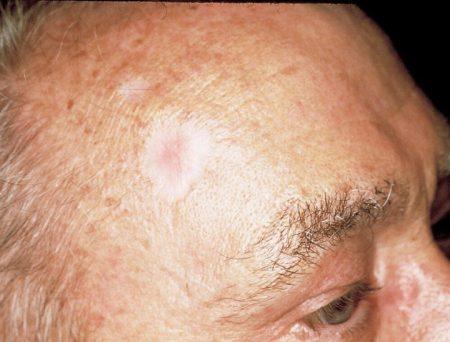 Bone Cancer of the FaceAll Youd Like to Know