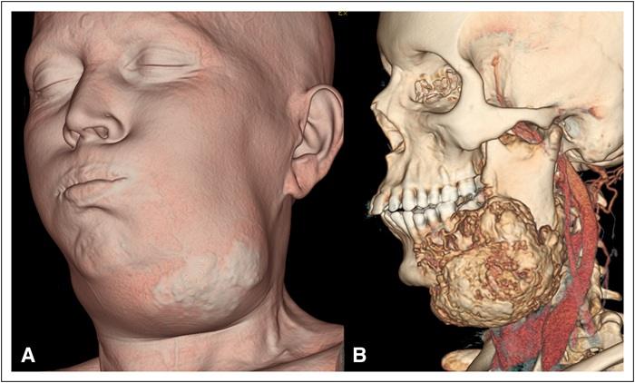 How Is Bone Cancer of the Face Diagnosed