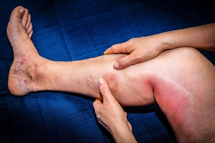 Symptoms of Blood Clot in the Leg