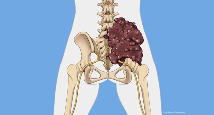 What Is Bone Cancer