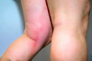 can you die from a blood clot in your leg