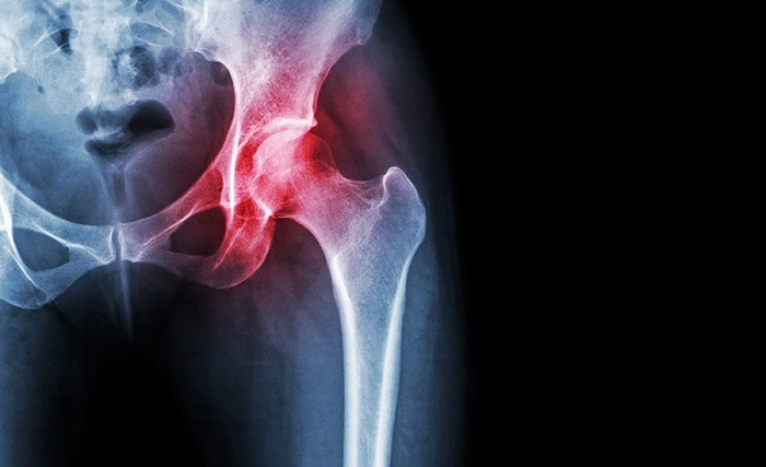 Diagnosis of Hip Injuries