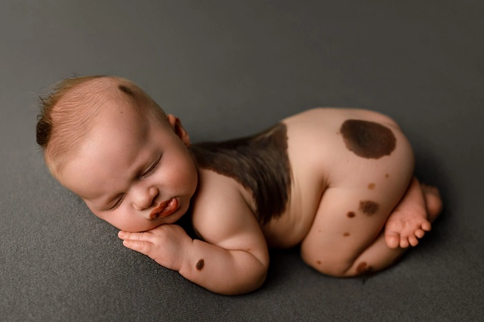 Living With a Hairy Nevus