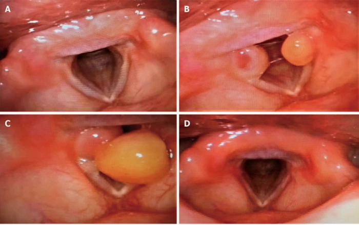 Recovery from Vocal Cord Granuloma 1