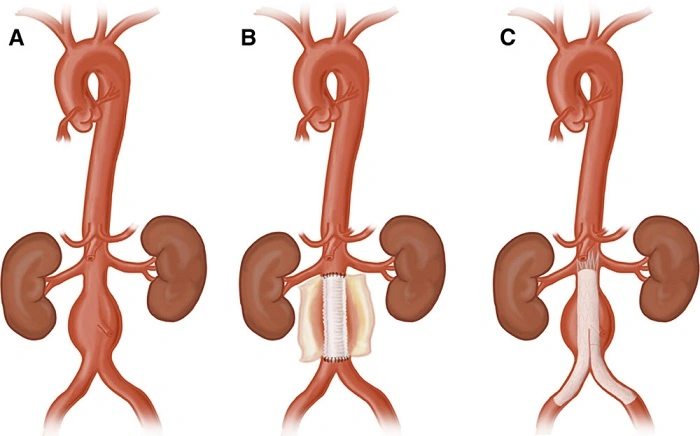 Risks of FEVAR Procedure