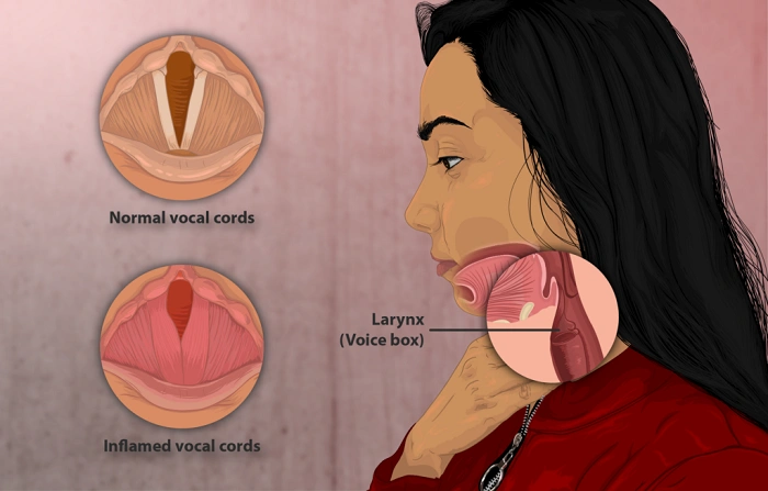 Treatment of Vocal Cord Atrophy