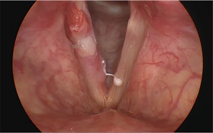 Treatment of Vocal Cord Leukoplakia