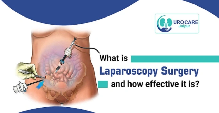 What Is Laparoscopy and How It Works