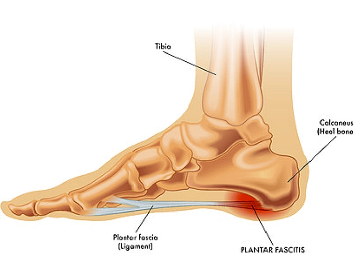 What Is Plantar Fasciitis