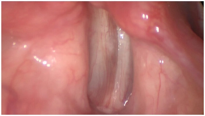What Is Vocal Cord Atrophy