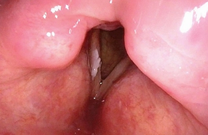 What Is Vocal Cord Leukoplakia