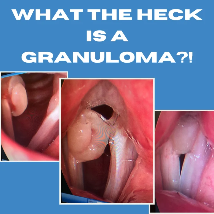 What Is a Vocal Cord Granuloma e1757590857358