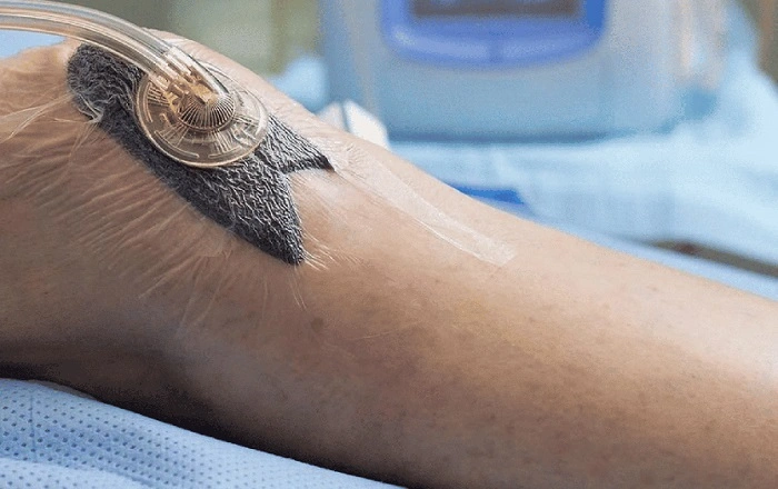 What Is a Wound VAC