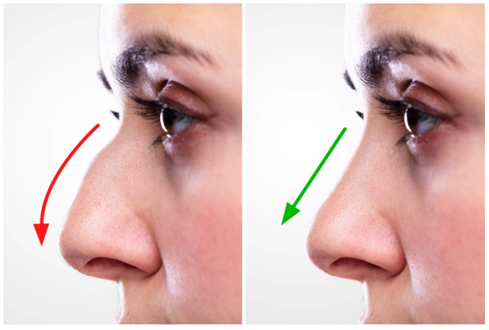 What is Rhinoplasty