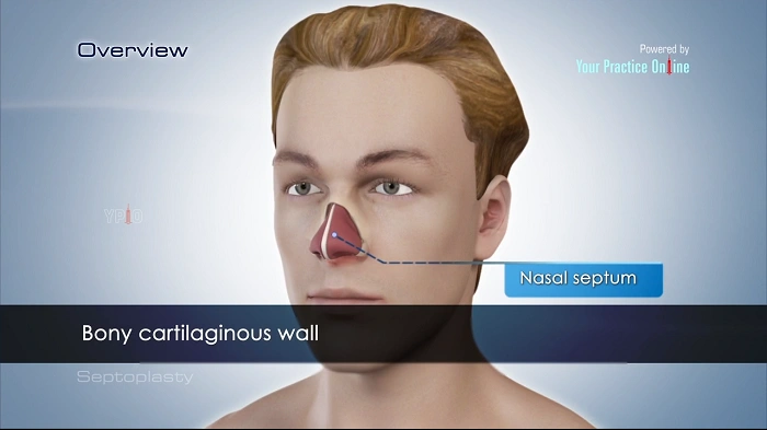 What is Septoplasty
