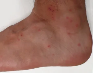 allergic reaction chigger bites