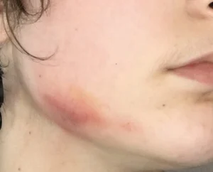 bruised jaw