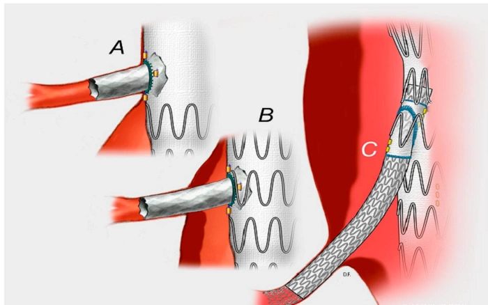 fevar procedure 1