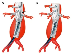 fevar procedure