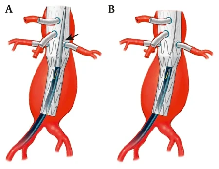 fevar procedure