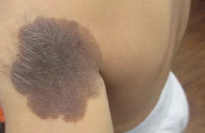 hairy nevus