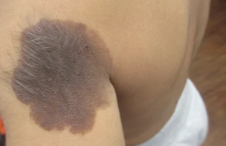hairy nevus