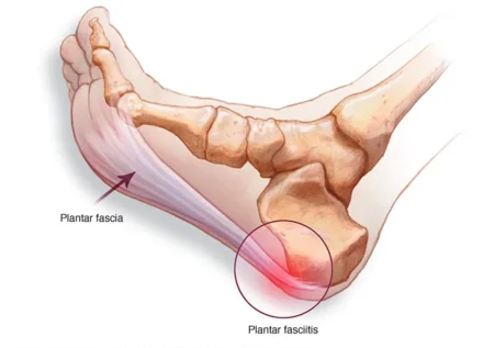 how to prevent plantar fasciitis