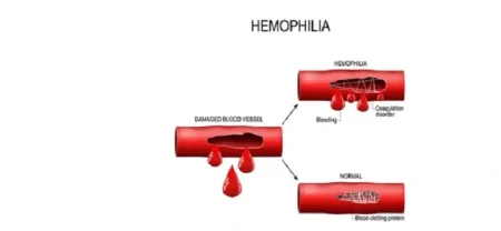 is hemophilia curable