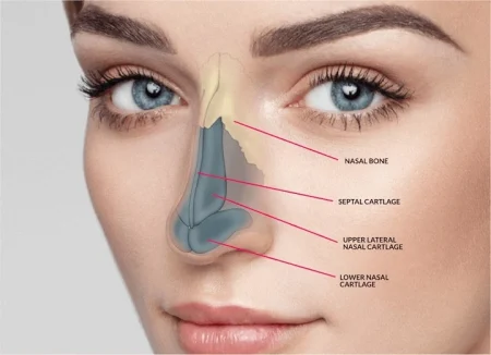 rhinoplasty