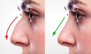 septoplasty