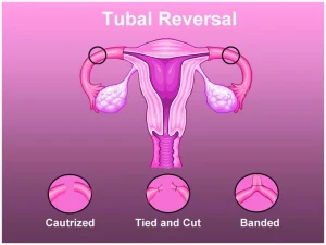 tubal ligation reversal near me