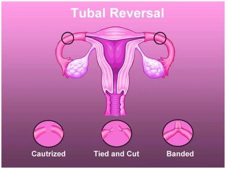 tubal ligation reversal near me