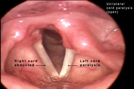 vocal cord atrophy