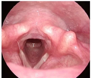 vocal cord granuloma
