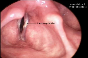 vocal cord leukoplakia