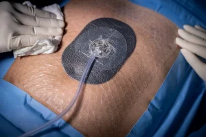 wound vac